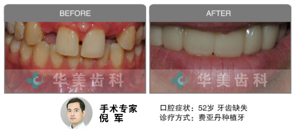 费亚丹种植牙修复牙齿缺失前后效果图对比图片