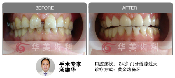 黄金烤瓷牙门牙缝隙过大对比图