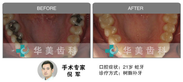 树脂补牙前后效果图对比图片